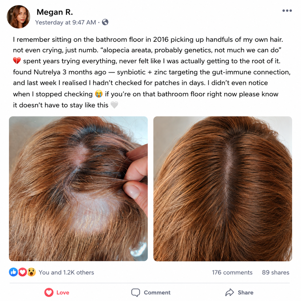 Nutrelya Patchy Hair Loss Treatment