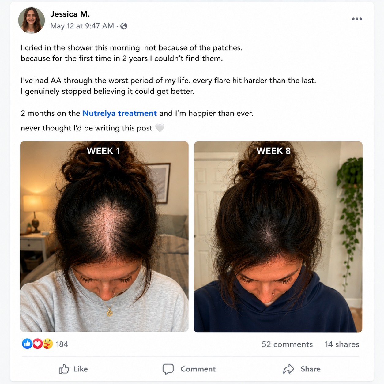 Nutrelya Patchy Hair Loss Treatment